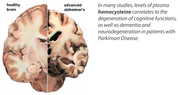healthy brain and advanced alzheimer's